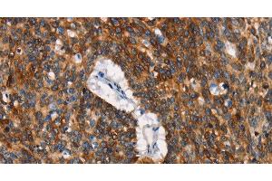 Immunohistochemistry of paraffin-embedded Human lung cancer tissue using CD68 Polyclonal Antibody at dilution 1:30 (CD68 anticorps)