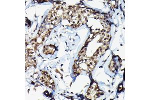 Immunohistochemistry of paraffin-embedded human breast cancer using SUFU Rabbit pAb (ABIN6133029, ABIN6148692, ABIN6148694 and ABIN6217424) at dilution of 1:100 (40x lens). (SUFUH anticorps  (AA 325-484))