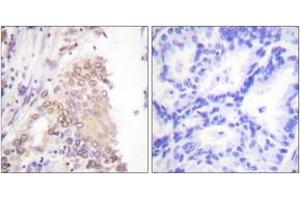 Immunohistochemistry analysis of paraffin-embedded human lung carcinoma tissue, using AML1 (Ab-276) Antibody. (RUNX1 anticorps  (AA 242-291))