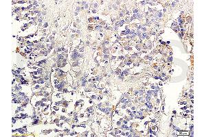 Formalin-fixed and paraffin embedded human colon carcinoma labeled with Anti-TGF-beta-2 Polyclonal Antibody, Unconjugated (ABIN724880) 1:300 followed by conjugation to the secondary antibody and DAB staining (TGF beta 2 Propeptide (AA 154-197) anticorps)
