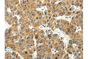The image on the left is immunohistochemistry of paraffin-embedded Human liver cancer tissue using ABIN7193045(WFDC1 Antibody) at dilution 1/35, on the right is treated with synthetic peptide. (WFDC1 anticorps)