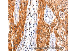 Immunohistochemistry of Human liver cancer using FBLN1 Polyclonal Antibody at dilution of 1:47 (Fibulin 1 anticorps)