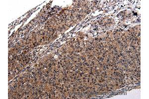 Immunohistochemistry of Human renal cancer using RAB41 Polyclonal Antibody at dilution of 1:100 (RAB41 anticorps)