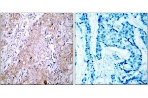 Immunohistochemistry analysis of paraffin-embedded human breast carcinoma tissue, using EGFR (Ab-1070) Antibody. (EGFR anticorps  (AA 1041-1090))