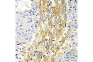 Immunohistochemistry of paraffin-embedded human oophoroma using FLNA antibody at dilution of 1:100 (400x lens). (Filamin A anticorps)