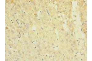 Immunohistochemistry of paraffin-embedded human liver cancer using ABIN7172869 at dilution of 1:100 (TRPM7 anticorps  (AA 756-855))