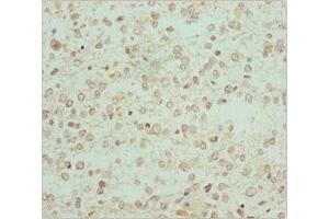 Immunohistochemistry of paraffin-embedded human glioma using ABIN7167743 at dilution of 1:100 (RCN2 anticorps  (AA 23-180))