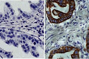 Paraffin embedded human gastric cancer tissue was stained with Mouse IgG2a-HRP isotype control followed by DAB and hematoxylin. (Cytokeratin 19 anticorps  (C-Term))