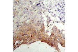 Immunohistochemical analysis of TSC2 staining in human prostate cancer formalin fixed paraffin embedded tissue section. (Tuberin anticorps)