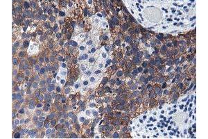 Immunohistochemical staining of paraffin-embedded Carcinoma of Human kidney tissue using anti-ALDH1L1 mouse monoclonal antibody. (ALDH1L1 anticorps)