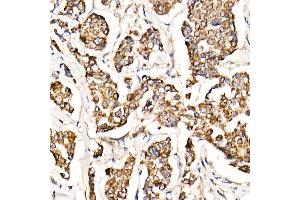 Immunohistochemistry of paraffin-embedded human breast cancer using [KO Validated] MyD88 Rabbit mAb (ABIN7268723) at dilution of 1:1000 (40x lens). (MYD88 anticorps)