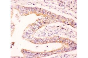 IHC-P: MCL1 antibody testing of human intestine cancer tissue (MCL-1 anticorps  (AA 1-350))