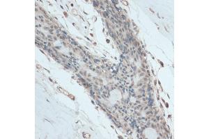 Immunohistochemistry of paraffin-embedded human breast using antibody (ABIN6130837, ABIN6140958, ABIN6140959 and ABIN6214740) at dilution of 1:100 (40x lens). (GAPDHS anticorps  (AA 179-408))