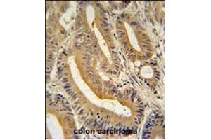 S1 antibody (N-term) (ABIN654456 and ABIN2844190) immunohistochemistry analysis in formalin fixed and paraffin embedded human colon carcinoma followed by peroxidase conjugation of the secondary antibody and DAB staining. (AP3S1 anticorps  (N-Term))