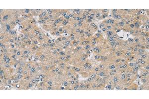 Immunohistochemistry of paraffin-embedded Human liver cancer using SMOC2 Polyclonal Antibody at dilution of 1:30 (SMOC2 anticorps)