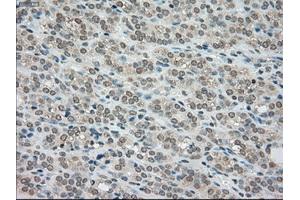 Immunohistochemical staining of paraffin-embedded Carcinoma of kidney tissue using anti-BUB1Bmouse monoclonal antibody. (BUB1B anticorps)
