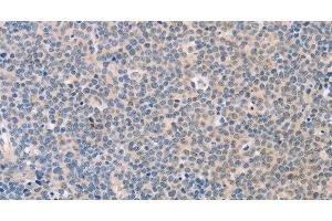 Immunohistochemistry of paraffin-embedded Human Lymphoma tissue using CD56 Polyclonal Antibody at dilution 1:30 (CD56 anticorps)