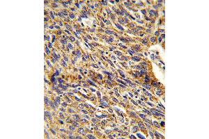 Formalin-fixed and paraffin-embedded human lung carcinoma reacted with DCI Antibody , which was peroxidase-conjugated to the secondary antibody, followed by DAB staining. (DCI anticorps  (C-Term))