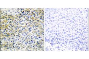 Immunohistochemistry analysis of paraffin-embedded human liver carcinoma tissue using CARKL antibody. (SHPK anticorps  (N-Term))