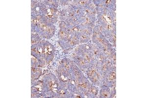 Immunohistochemical analysis of (ABIN387989 and ABIN2845007) on paraffin-embedded Human colon carcinoma tissue was performed on the Leica®BOND RXm. (IFITM3 anticorps  (N-Term))