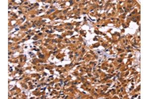 The image on the left is immunohistochemistry of paraffin-embedded Human thyroid cancer tissue using ABIN7130270(MSH4 Antibody) at dilution 1/30, on the right is treated with fusion protein. (MSH4 anticorps)