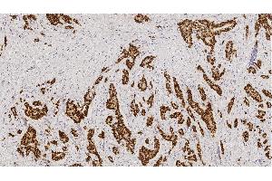 Left: Invasive ductal carcinoma (high expressor): intense nuclear staining in nearly 100 % of tumor cells. (Estrogen Receptor alpha anticorps)