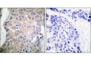 Immunohistochemistry analysis of paraffin-embedded human breast carcinoma tissue, using CPI17 alpha (Ab-38) Antibody. (CPI-17 anticorps  (AA 5-54))