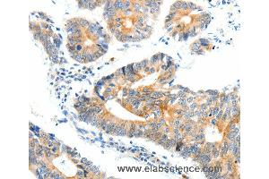 Immunohistochemistry of Human ovarian cancer using NTRK1 Polyclonal Antibody at dilution of 1:90 (TRKA anticorps)