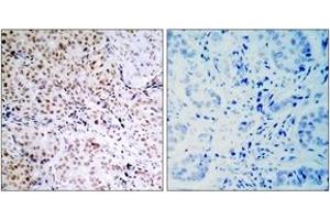 Immunohistochemistry (IHC) image for anti-Retinoblastoma Protein (Rb Protein) (pSer795) antibody (ABIN2888520) (Retinoblastoma Protein (Rb) anticorps  (pSer795))
