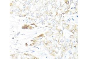 Immunohistochemistry of paraffin-embedded Human liver cancer using HSD17B10 Polyclonal Antibody at dilution of 1:100 (40x lens). (HSD17B10 anticorps)