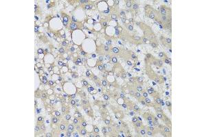 Immunohistochemistry of paraffin-embedded human liver injury using PRODH antibody at dilution of 1:100 (x40 lens). (PRODH anticorps)