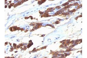 Formalin-fixed, paraffin-embedded human Thyroid Carcinoma stained with Thyroglobulin Monoclonal Antibody (SPM221). (Thyroglobulin anticorps)