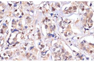 Immunohistochemistry of paraffin-embedded Human breast cancer using STK4 Polyclonal Antibody at dilution of 1:100 (40x lens). (STK4 anticorps)