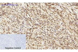 Immunohistochemical analysis of paraffin-embedded human uterus cancer tissue. (Calnexin anticorps)