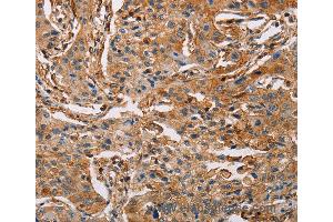 Immunohistochemistry of Human lung cancer using ACTA1 Polyclonal Antibody at dilution of 1:65 (Actin anticorps)