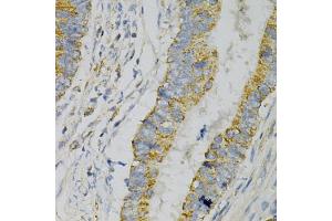 Immunohistochemistry of paraffin-embedded human colon carcinoma using GNAO1 Antibody (ABIN1872843) at dilution of 1:100 (40x lens). (GNAO1 anticorps)