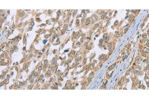 Immunohistochemistry of paraffin-embedded Human esophagus cancer using ECHS1 Polyclonal Antibody at dilution of 1:35 (ECHS1 anticorps)