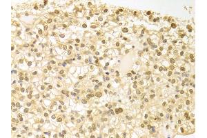 Immunohistochemistry of paraffin-embedded human kidney cancer using PLCB1 antibody (ABIN5971022) at dilution of 1/100 (40x lens). (Phospholipase C beta 1 anticorps)