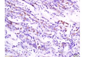 Formalin-fixed and paraffin embedded human stomach carcinoma labeled withAnti-Folate Receptor 4 Polyclonal Antibody, Unconjugated  at 1:200 followed by conjugation to the secondary antibody and DAB staining. (Folate Receptor 4 anticorps)