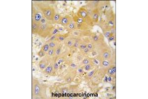 Formalin-fixed and paraffin-embedded human hepatocarcinoma tissue reacted with LAP3 antibody , which was peroxidase-conjugated to the secondary antibody, followed by DAB staining. (LAP3 anticorps  (N-Term))