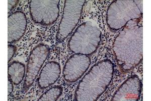 Immunohistochemistry (IHC) analysis of paraffin-embedded Human Colon Cancer, antibody was diluted at 1:100. (Lipocalin 1 anticorps  (Internal Region))