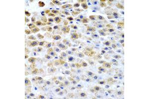 Immunohistochemistry of paraffin-embedded human liver cancer using TFPI2 antibody (ABIN5975010) at dilution of 1/200 (40x lens). (TFPI2 anticorps)