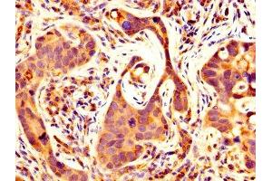 IHC image of ABIN7159063 diluted at 1:500 and staining in paraffin-embedded human pancreatic cancer performed on a Leica BondTM system. (MMP14 anticorps  (AA 112-582))