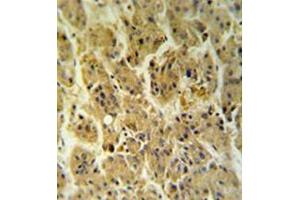 Immunohistochemistryanalysis in formalin fixed and paraffin embedded hepatocarcinoma reacted with NDUFS2 Antibody (Center) followed which was peroxidase conjugated to the secondary antibody and followed by DAB staining. (NDUFS2 anticorps  (Middle Region))