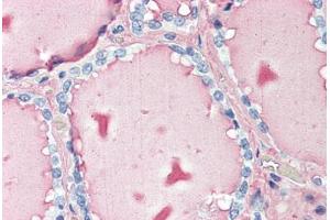 Human Thyroid (formalin-fixed, paraffin-embedded) stained with TG antibody ABIN396965 at 10 ug/ml followed by biotinylated anti-mouse IgG secondary antibody ABIN481714, alkaline phosphatase-streptavidin and chromogen. (Thyroglobulin anticorps)