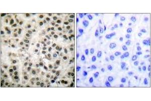 Immunohistochemistry analysis of paraffin-embedded human breast carcinoma tissue, using MEF2A (Ab-408) Antibody. (MEF2A anticorps  (AA 374-423))
