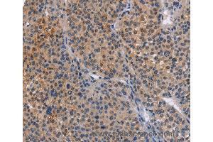 Immunohistochemistry of Human cervical cancer using MAP3K13 Polyclonal Antibody at dilution of 1:40 (MAP3K13 anticorps)
