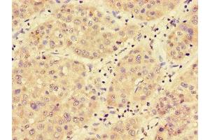 Immunohistochemistry of paraffin-embedded human liver cancer using ABIN7159112 at dilution of 1:100 (MED17 anticorps  (AA 411-651))