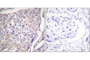 Immunohistochemistry analysis of paraffin-embedded human breast carcinoma, using p70 S6 Kinase (Phospho-Ser418) Antibody. (RPS6KB1 anticorps  (pSer418))