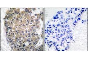 Immunohistochemistry analysis of paraffin-embedded human breast carcinoma tissue, using Keratin 17 Antibody. (KRT17 anticorps  (AA 381-430))